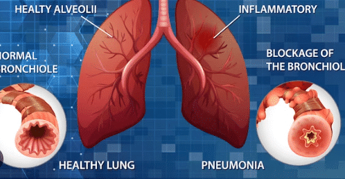 inflammation des poumons
